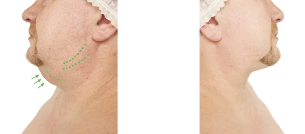 male double chin tightening before and after procedures