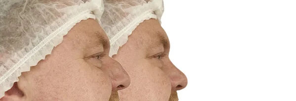 Корекція Носа Людини Після Процедур — стокове фото