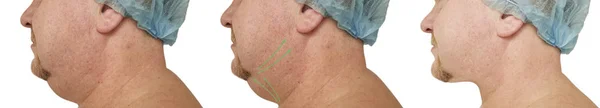 Male Double Chin Correction Procedures — Stock Photo, Image