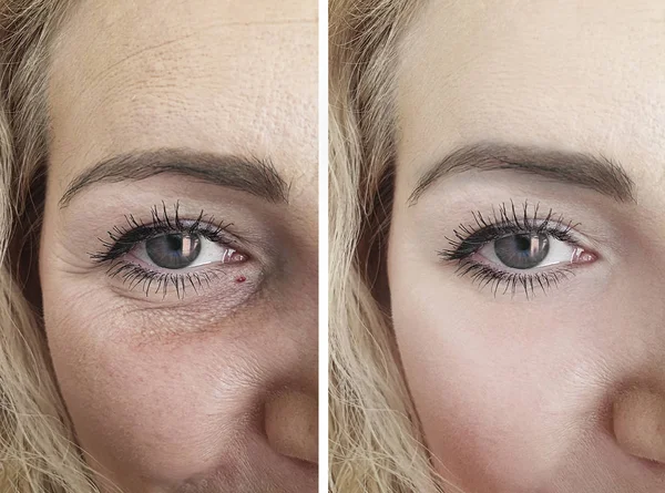 Ojos Femeninos Arrugas Antes Después Los Procedimientos Corrección —  Fotos de Stock