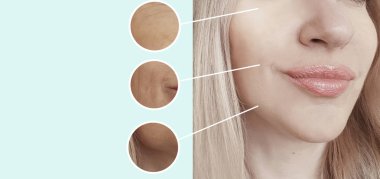 kadın kırışıklıkları yüz öncesi ve sonrası yordamları kolaj