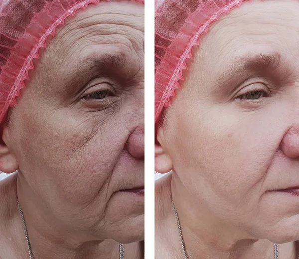 Face Older Woman Treatments — Stock Photo, Image