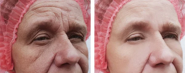 顔しわ高齢者女性の前に と後の手順 — ストック写真