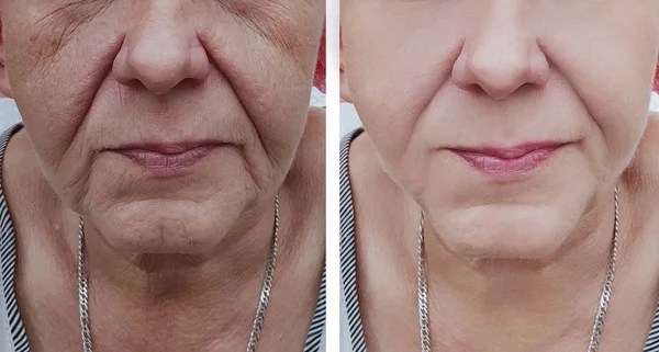 Yüz Kırışıklıkları Yaşlı Kadın Öncesi Sonrası Yordamları — Stok fotoğraf