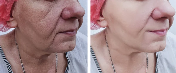 Face Wrinkles Elderly Woman Procedures — Stock Photo, Image