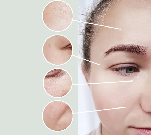 Woman Eyes Wrinkles Bloating Procedures Collage — Stock Photo, Image