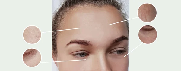 Arrugas Mujer Antes Después Procedimientos — Foto de Stock