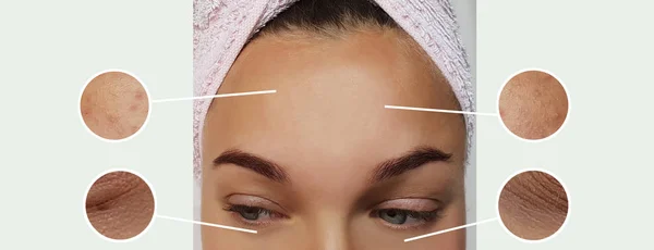Arrugas Mujer Antes Después Los Procedimientos Collage — Foto de Stock
