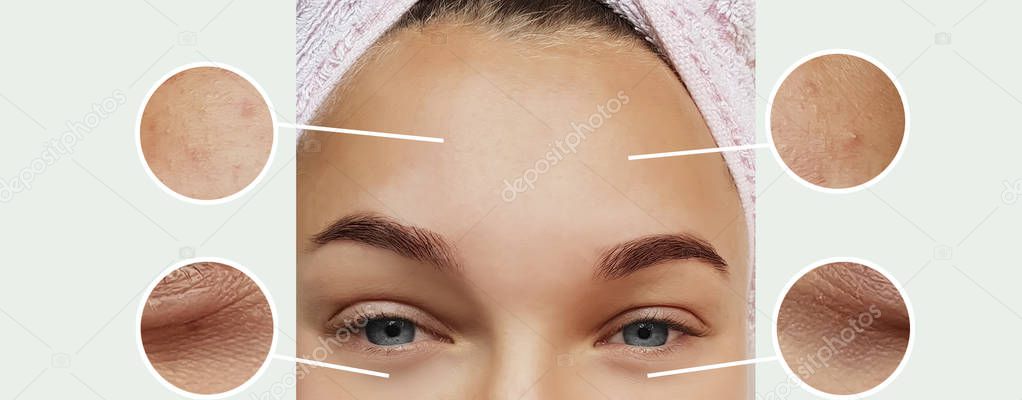 woman wrinkles before and after procedures collage