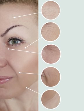 kadın kırışıklıkları öncesi ve tedavi sonrası