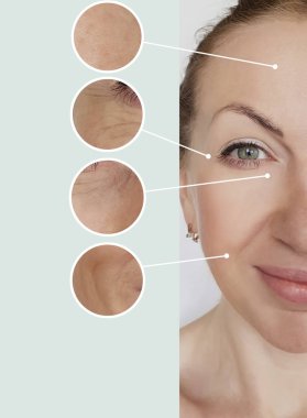 kadın kırışıklıkları öncesi ve tedavi sonrası