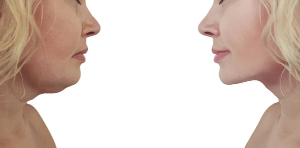 Woman Double Chin Procedures — Stock Photo, Image