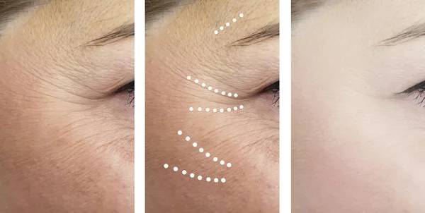Arrugas Mujer Antes Después Los Procedimientos Collage —  Fotos de Stock