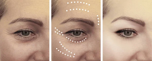 Arrugas Mujer Antes Después Los Procedimientos Collage — Foto de Stock
