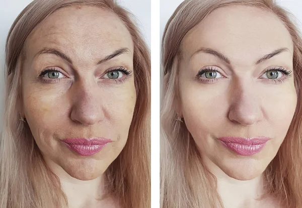 woman wrinkles face before and after procedures