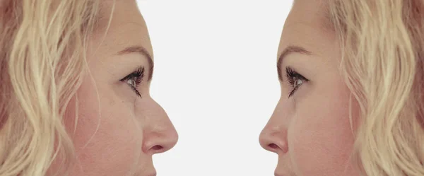Wanita Hidung Punuk Sebelum Dan Setelah Prosedur — Stok Foto