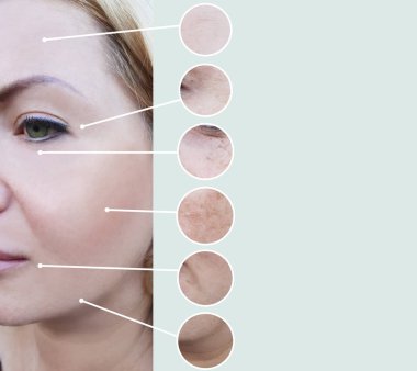 kadın kırışıklıkları öncesi ve sonrası yordamları