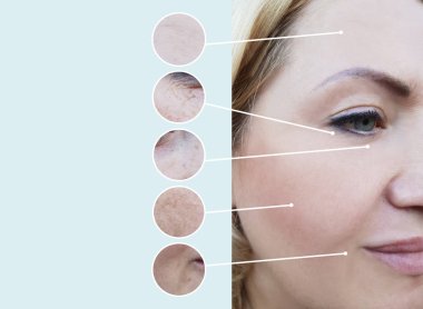 kadın kırışıklıkları öncesi ve sonrası yordamları