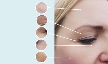 kadın kırışıklıkları öncesi ve sonrası yordamları