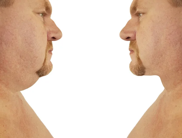 男性双下巴矫正前后的程序 — 图库照片