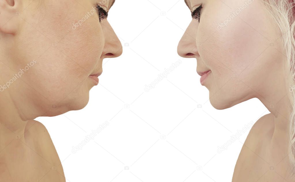 beautiful woman double chin lift before and after correction procedures