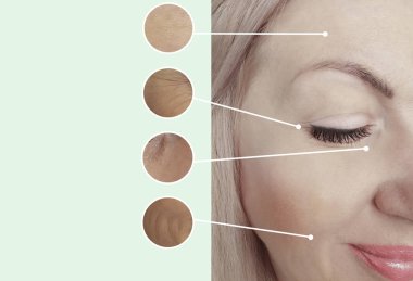 kadın kırışıklıkları öncesi ve sonrası kolaj yordamları