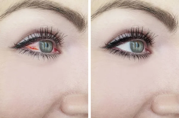 Mulher Olhos Vermelhos Antes Depois Dos Tratamentos — Fotografia de Stock