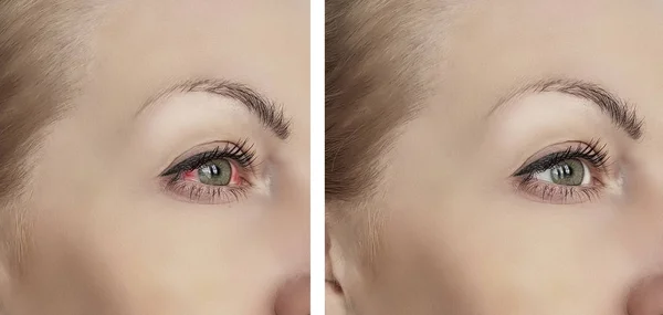 Ojos Rojos Mujer Antes Después Procedimientos —  Fotos de Stock