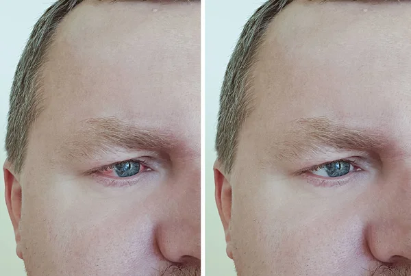 Άνθρωπος Που Είναι Κόκκινο Μάτι Πριν Και Μετά Θεραπεία — Φωτογραφία Αρχείου