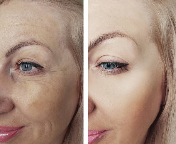 female wrinkles before and after correction procedures