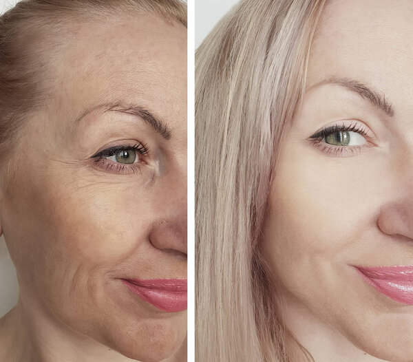 female wrinkles before and after correction procedures