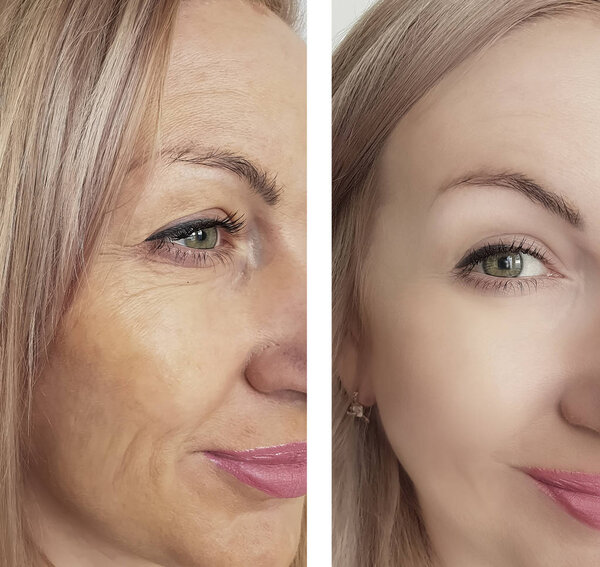 female wrinkles before and after correction procedures