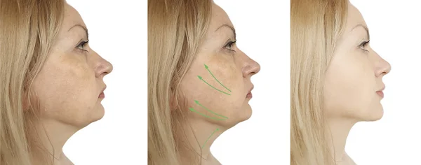 Female Double Chin Procedures — Stock Photo, Image
