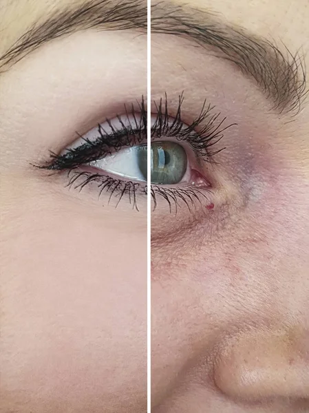 Глаза Женщины Морщинки После Процедур — стоковое фото