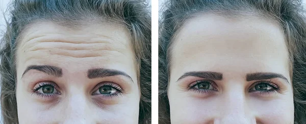 Girl Forehead Wrinkles Procedures — Stock Photo, Image