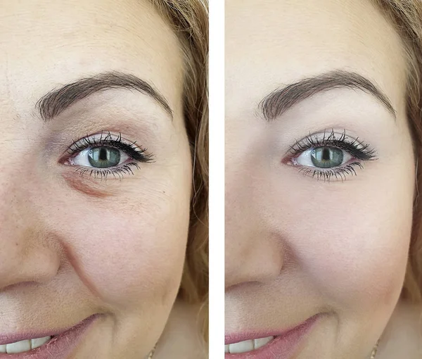 Mujer Cara Ojos Arrugas Antes Después Los Procedimientos — Foto de Stock