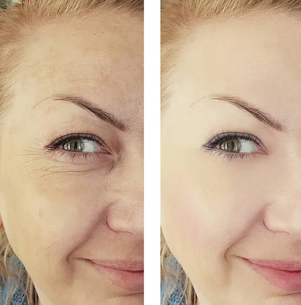 Weibliche Augenfalten Vor Und Nach Eingriffen — Stockfoto