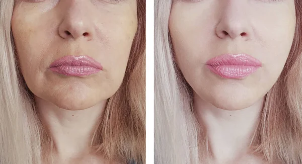 Arrugas Mujer Antes Después Procedimientos —  Fotos de Stock