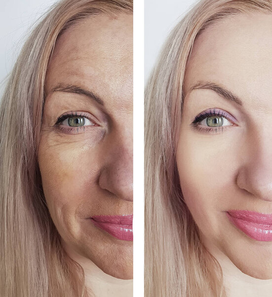 woman wrinkles before and after procedures