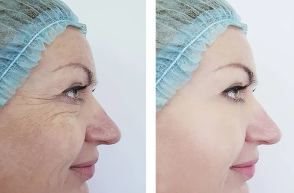Woman Wrinkles Procedures — Stock Photo, Image