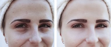 kadın gözü önce ve sonra kaldırma prosedürleri kırışıklıkları