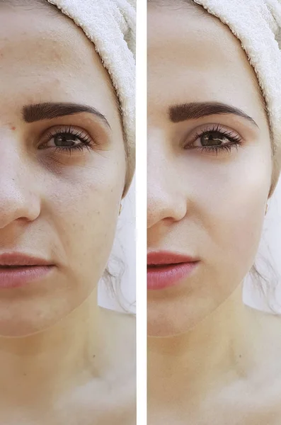 女性眼睛皱纹前后解除程序 — 图库照片