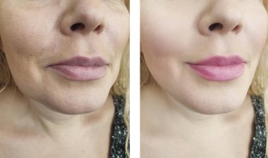 kadın kırışıklıkları önce ve sonra yordamı