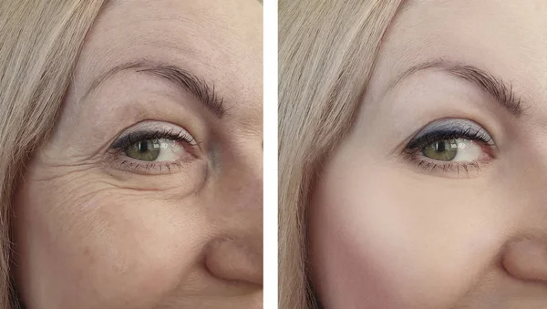 Жіночі Зморшки Очей Після Процедур — стокове фото