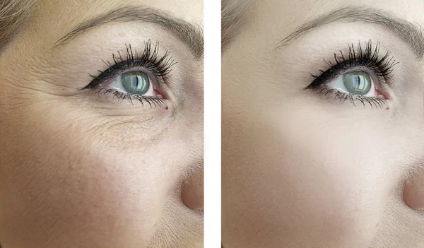 Arrugas Oculares Mujer Antes Después Procedimientos —  Fotos de Stock