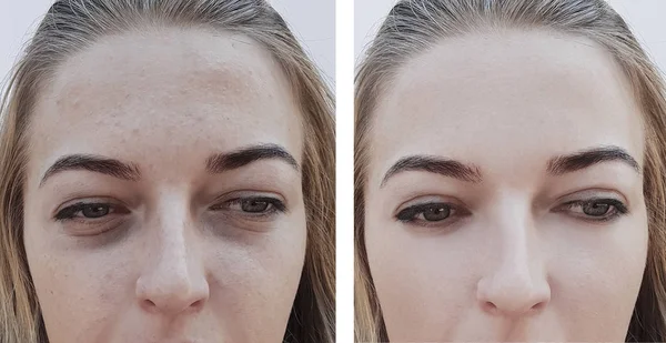 Girl Wrinkles Eye Bags Procedures — Stock Photo, Image