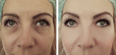 kadın gözleri önce ve sonra prosedürler kolaj kırışıklıkları