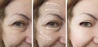 kadın gözü önce ve sonra prosedürler kolaj kırışıklıkları