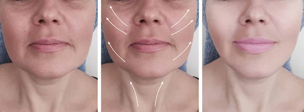 Wanita Keriput Wajah Sebelum Dan Setelah Prosedur Kolase — Stok Foto