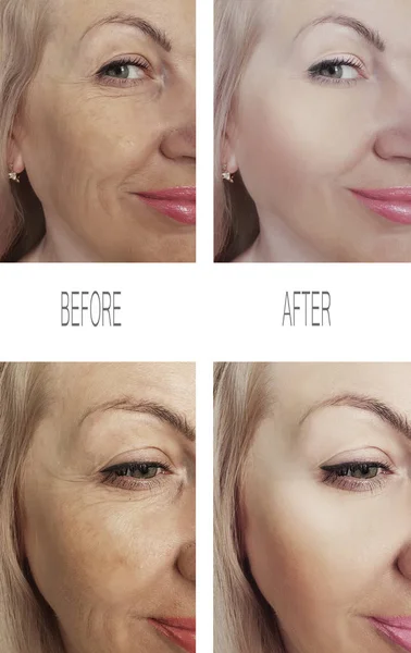 Arrugas Mujer Cara Antes Después Los Procedimientos Eliminación — Foto de Stock
